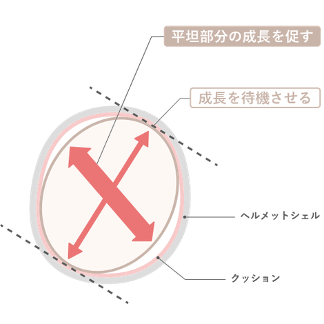 ヘルメット治療のイメージ図